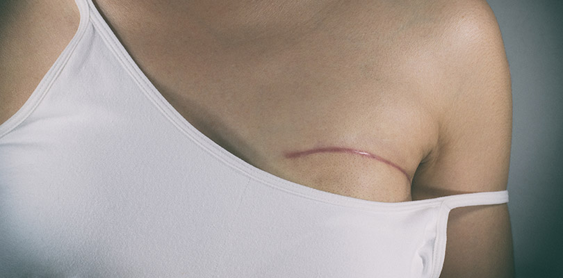 A mastectomy scar from breast cancer surgery