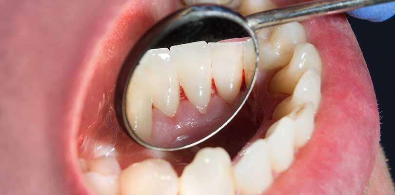 A dentist doing an oral exam, showing bleeding gums